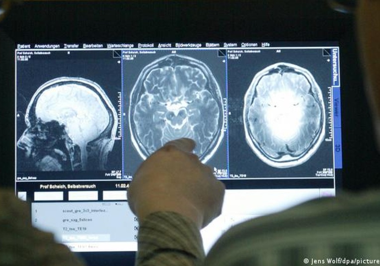 Nuevo medicamento entrega resultados prometedores en tratamiento contra el Alzheimer nuevo-medicamento-entrega-resultados-prometedores-en-tratamiento-contra-el-alzheimer-124442-124532.jpg