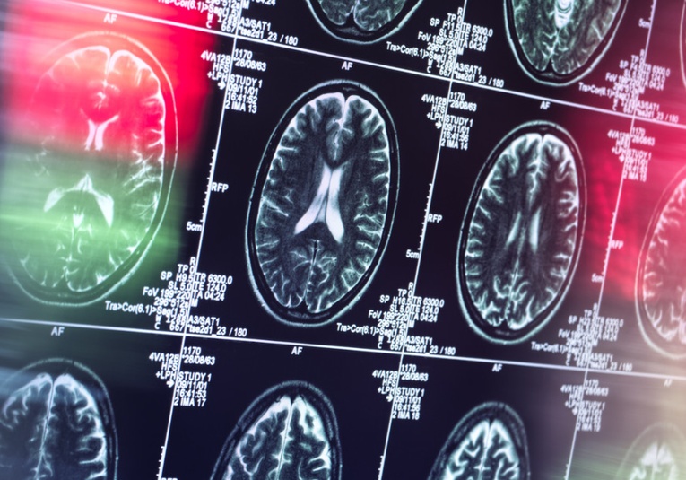 Un nuevo fármaco ralentiza el deterioro cognitivo por el alzhéimer en su etapa temprana un-nuevo-f-rmaco-ralentiza-el-deterioro-cognitivo-por-el-alzheimer-en-su-etapa-temprana-091734-091811.jpg