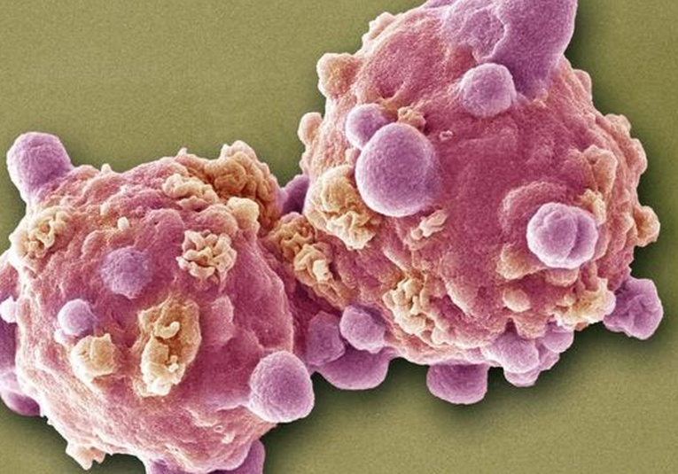 Una pastilla experimental logra remitir la leucemia avanzada en 18 pacientes una-pastilla-experimental-logra-remitir-la-leucemia-avanzada-en-18-pacientes-154305-154321.jpg